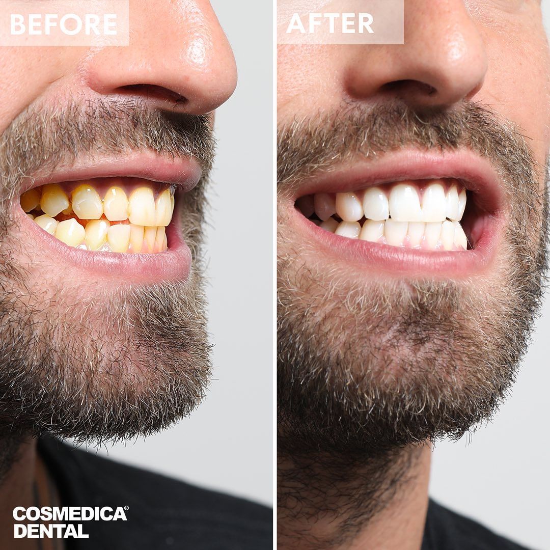 Männlicher Patient der Cosmedica Dental Zahnklinik in Istanbul vor und nach einer Zahnaufhellung; Vorher-nachher Vergleich